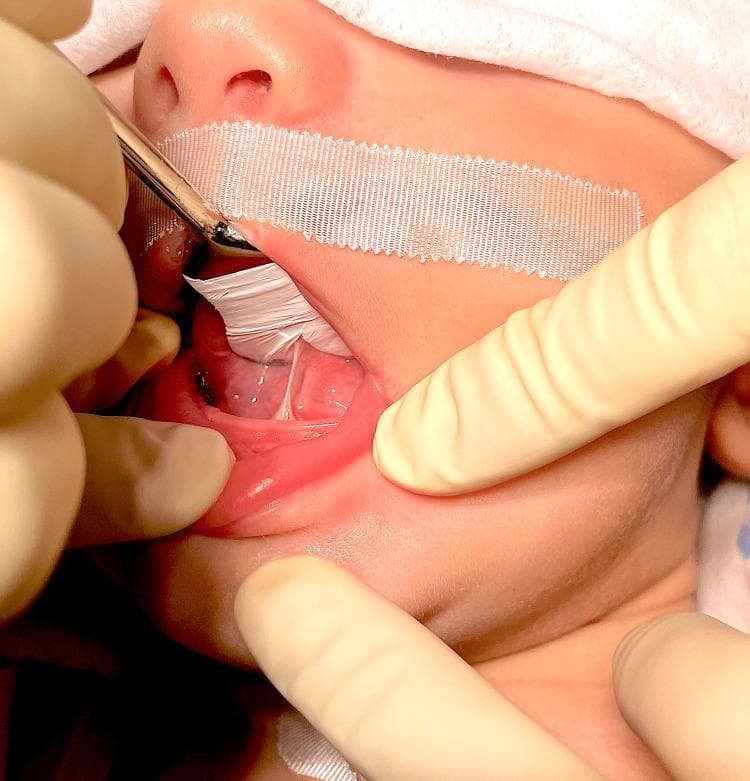 This clinical photograph shows the oral cavity of an infant being examined for ankyloglossia (tongue-tie). The image demonstrates a restricted lingual frenulum, appearing as a tight, thin, membranous band of tissue connecting the ventral surface of the tongue to the floor of the mouth. The attachment is located close to the tongue tip, significantly limiting the tongue's range of motion and upward extension. During the examination, gloved fingers are used to retract the lips and stabilize the jaw, while a metallic grooved director or tongue elevator, assisted by white surgical gauze, lifts the tongue to expose the sublingual anatomy. A white adhesive bandage is visible on the upper lip, likely securing a medical device or providing stabilization during a pediatric procedure. This visual is characteristic of Coryllos grade 1 or 2 ankyloglossia, a condition often associated with breastfeeding difficulties. The image serves as an educational example for pediatric dentistry and otolaryngology regarding the diagnostic assessment of lingual restrictive tissues prior to frenotomy.