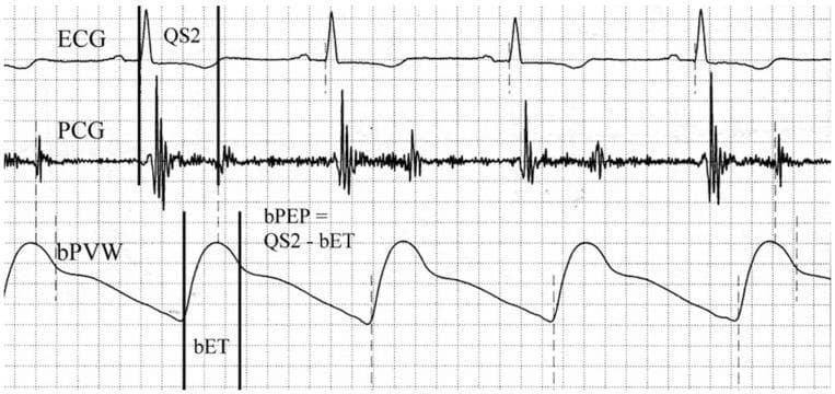 This physiological waveform diagram displays a simultaneous recording of three cardiac parameters used for assessing cardiovascular hemodynamics. The top trace is an Electrocardiogram (ECG) showing standard QRS complexes representing ventricular depolarization. The middle trace is a Phonocardiogram (PCG) capturing acoustic vibrations of heart sounds, specifically the S1 and S2 sounds. The bottom trace is a Brachial Pulse Volume Waveform (bPVW) illustrating the peripheral arterial pressure pulse. Vertical markers indicate temporal relationships between these signals to calculate systolic time intervals. The 'QS2' interval is marked from the onset of the QRS complex on the ECG to the aortic component of the second heart sound on the PCG, representing the total electromechanical systolic interval. The 'bET' (Brachial Ejection Time) is delineated on the bPVW from the waveform foot to the dicrotic notch. An annotated formula shows the calculation of the Brachial Pre-ejection Period (bPEP) as the difference between QS2 and bET (bPEP = QS2 - bET). This diagram is an educational tool for understanding the non-invasive assessment of cardiac systolic function and arterial stiffness.
