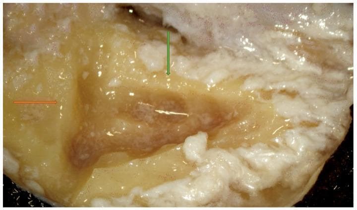This clinical photograph displays a right-sided mastoidectomy dissection, focusing on the identification of Macewen’s suprameatal triangle. The image depicts the temporal bone cortex with initial surgical incisions. An orange arrow indicates the first straight cut made along the temporal line, which serves as the superior boundary of the attack triangle. A green arrow identifies a second cut made perpendicular to the first, positioned immediately posterior to the posterior ear canal wall. The surgical site exhibits characteristic yellowish-white bone texture with moist, reflective surfaces from irrigation. The defined triangular area serves as a critical anatomical landmark for ENT residents and surgeons to safely begin bone drilling and subsequent mastoid antrum identification. This pedagogical image illustrates the initial steps of otological surgery, emphasizing the importance of establishing accurate landmarks to avoid injury to deeper structures such as the middle cranial fossa dura or the facial nerve.