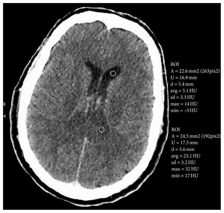 Diagnostic Imaging: This axial view of a cranial non-contrast computed tomography (CT) scan shows the internal structures of the brain with two defined regions of interest (ROI) for quantitative analysis. The primary finding is the presence of hyperdense material layered within the dependent portions of the posterior lateral ventricles. Quantitative ROI analysis reveals an average density of approximately 23.1 Hounsfield Units (HU) for this sediment (ROI #2), compared to 5.1 HU for normal cerebrospinal fluid (CSF) in the anterior horns (ROI #1). Morphologically, these hyperdense sedimentations demonstrate a fluid-debris level, a finding classically associated with intraventricular hemorrhage or the presence of inflammatory exudate (pus) in the context of ventriculitis. The brain parenchyma is visualized without obvious midline shift or mass effect. This image is medically significant for teaching the radiological identification of abnormal intraventricular densities and the use of Hounsfield Units to differentiate fluid types in neuroimaging, particularly in patients with suspected sepsis or coagulopathy.
