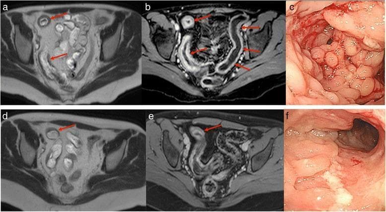 This composite figure illustrates the progression and monitoring of Crohn's disease (CD) in the distal ileum using magnetic resonance imaging (MRI) and endoscopy. Panels (a, b) show axial MRI baseline scans demonstrating severe active inflammation characterized by marked bowel wall thickening, mural edema, and prominent stratified hyperenhancement (target sign) in the terminal ileum. Panel (c) provides the corresponding baseline endoscopic view, revealing classic 'cobblestone' mucosal patterns and luminal narrowing (stricturing). Following 26 weeks of infliximab (IFX) treatment, panels (d, e) show interval improvement on MRI, with reduced wall thickness and milder contrast enhancement, though persistent moderate disease is noted. Panel (f) shows the week 26 endoscopic follow-up, where the cobblestone appearance has transitioned to irregular longitudinal ulcers. This comparison highlights the use of the Magnetic Resonance Index of Activity (MaRIA) score and Simple Endoscopic Score for Crohn’s Disease (SES-CD) to quantify therapeutic response and mucosal healing.