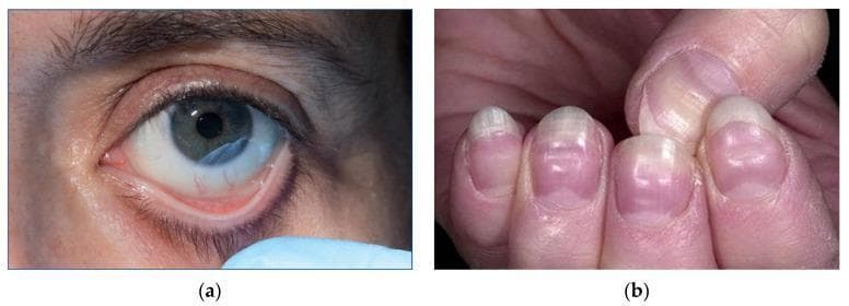 This composite of clinical photographs illustrates physical manifestations of severe anemia. Image (a) shows a close-up of a patient's eye with the lower eyelid retracted to reveal marked conjunctival pallor. The typically pink or reddish palpebral conjunctiva appears significantly pale and porcelain-white, a sign classically associated with a hemoglobin concentration below 90 g/L. Image (b) presents the fingernails of a patient demonstrating pronounced nail bed pallor. The distal nail beds lack the normal healthy pink hue. Additionally, horizontal white bands, known as Muehrcke's lines, are visible across the nail plates; these non-palpable transverse lines are associated with systemic conditions such as hypoalbuminemia and severe anemia. Together, these images demonstrate key external clinical signs used in the bedside assessment of hematological disorders and circulatory efficiency. The content is suitable for medical education regarding the physical examination findings of iron deficiency and other severe anemias.