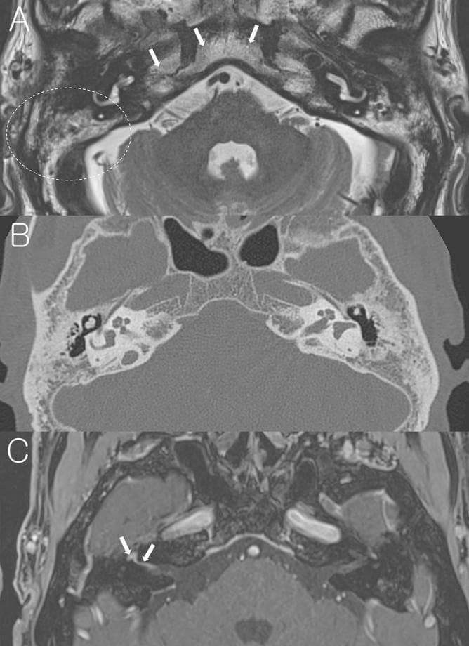 This composite figure consists of three axial imaging views of the temporal bone and skull base in a patient with Bell's palsy, demonstrating sclerotic mastoid changes. (A) Non-contrast axial T2-weighted MRI at the level of the internal auditory canal (IAC) shows heterogeneous high signal intensity within the mastoid air cell region (indicated by a dotted circle), matching the signal of the adjacent clivus and petrous apex marrow (arrows). (B) Axial temporal bone CT scan (TBCT) provides anatomical correlation, showing significant bony sclerotic changes and a marked reduction in the number of mastoid air cells compared to normal pneumatization. (C) Post-contrast axial T1-weighted MRI at the level of Bill's bar demonstrates pathologic enhancement of the right facial nerve involving the distal canalicular, labyrinthine, and geniculate ganglion segments (arrows). The images collectively illustrate how chronic mastoid sclerosis, an anatomical variant, can appear on MRI and CT, while also showing the characteristic nerve enhancement associated with acute peripheral facial nerve palsy.