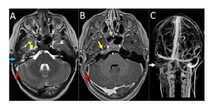This composite diagnostic image displays brain MRI findings in a patient with Gradenigo syndrome and associated complications. Panel A is an axial T2-weighted sequence showing hyperintense inflammatory changes in the right petrous apex (yellow arrow) and the right tympanic cavity (blue arrow), consistent with petrous apicitis and otomastoiditis. A red arrow indicates signal abnormality in the right sigmoid sinus. Panel B is a post-contrast T1-weighted axial image demonstrating peripheral enhancement in the right petrous apex (yellow arrow) and a filling defect in the sigmoid sinus (red arrow). Panel C presents a Time-of-Flight (TOF) venous MR angiography (MRV), which reveals a complete absence of flow signal in the right transverse sinus, sigmoid sinus, and internal jugular vein (white arrows), confirming extensive dural venous sinus thrombosis. The left-sided venous structures appear patent. These findings illustrate the infectious spread from the middle ear to the petrous apex and the subsequent development of intracranial venous thrombosis.