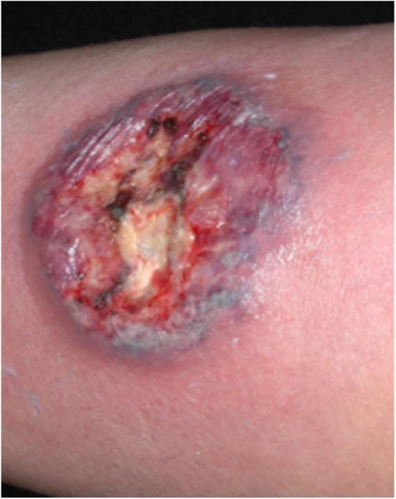 This clinical photograph displays a primary skin lesion characteristic of classic (ulcerative) pyoderma gangrenosum. The lesion presents as a deep, roughly circular ulcer with well-demarcated, irregular, and undermined borders. A defining diagnostic feature is the distinct violaceous (purple-hued) coloration of the peripheral margin. The central wound bed contains a mixture of yellowish-tan purulent material, areas of granulation tissue, and dark necrotic or hemorrhagic crusting. Immediately surrounding the violaceous border, there is a prominent erythematous inflammatory halo, indicating significant perilesional tissue infiltration and inflammation. This visual represents a neutrophilic dermatosis often associated with systemic conditions such as inflammatory bowel disease, rheumatoid arthritis, or hematologic malignancies. The image demonstrates key morphological signs used in dermatology for differentiating pyoderma gangrenosum from other chronic ulcers, such as venous stasis ulcers or cutaneous infections like leishmaniasis.