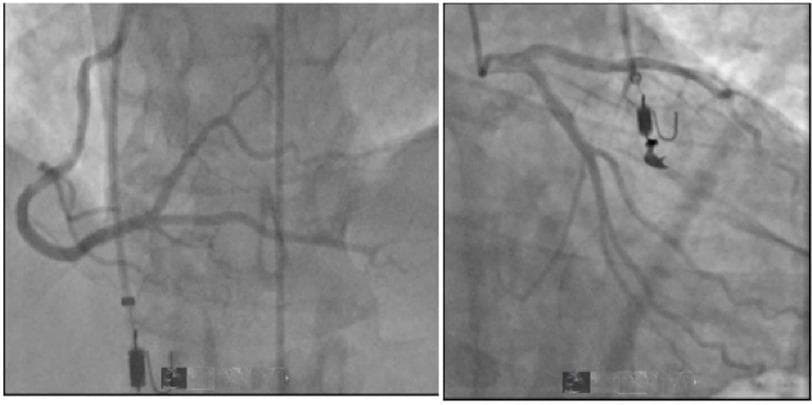 This diagnostic image consists of two grayscale fluoroscopic frames from a coronary angiography procedure, a subset of left heart catheterization. The image on the left shows the right coronary artery (RCA) and its primary branches. The image on the right depicts the left coronary system, including the left main, left anterior descending (LAD), and left circumflex (LCx) arteries. Both panels demonstrate radiopaque catheters selectively engaged in the coronary ostia, with contrast medium filling the lumen to reveal vascular anatomy. The coronary arteries exhibit smooth luminal borders and a patent course without evidence of focal stenosis, significant narrowing, or obstructive coronary artery disease. Small radiopaque surgical or procedural hardware elements are visible in the background of both panels. This material is used to teach cardiovascular assessment, specifically the use of angiography to rule out obstructive atherosclerosis in patients presenting with acute cardiac symptoms like chest pain or ST-segment changes.