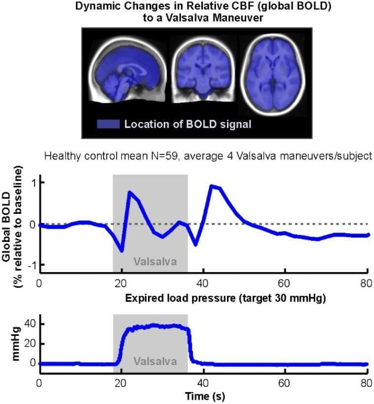 This figure illustrates dynamic changes in the global Blood Oxygen Level Dependent (BOLD) signal during a Valsalva maneuver in healthy subjects. The top panel presents three diagnostic images—sagittal, coronal, and axial fMRI sections—with blue overlays indicating that the global BOLD signal was calculated from nearly the entire brain volume, including the cerebral hemispheres, cerebellum, and brainstem. The middle plot displays the mean 'Global BOLD (% relative to baseline)' over time (0–80 seconds). It shows a biphasic response: a sharp initial decrease at the start of the maneuver, followed by an increase above baseline during the strain phase, a second drop upon release, and a subsequent recovery overshoot. The bottom plot shows the 'Expired load pressure (mmHg)', documenting the target physiological challenge of 30 mmHg maintained between approximately 18 and 38 seconds. Together, these elements demonstrate the use of global BOLD as an indirect measure of cerebral blood flow and autoregulatory responses to autonomic cardiovascular challenges.