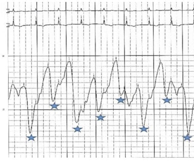 This diagnostic hemodynamic tracing displays a right atrial (RA) pressure waveform alongside a concurrent electrocardiogram (ECG) lead. The upper section shows a standard ECG rhythm with regular QRS complexes, which serve as a temporal reference for the mechanical events of the cardiac cycle. The lower section depicts the RA pressure tracing, characterized by a significantly elevated mean pressure (approximately 33 mmHg) persisting after pericardiocentesis. The most notable morphologic feature is the presence of sharp, deep 'y' descents, indicated by blue asterisks on the tracing. These descents represent rapid atrial emptying during early ventricular diastole. The combined findings of elevated RA pressure and prominent 'y' descents are visually characteristic of constrictive or effusive-constrictive pericarditis. The tracing illustrates the loss of normal pressure-volume relationships in the right heart due to external restriction, providing a classic example of hemodynamic 'tamponade-like' physiology transitioning toward constriction.