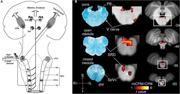 Educational medical graphic illustrating nociceptive pathways and brainstem fMRI activity related to pain modulation. Panel A is a neuroanatomical diagram showing the trigeminothalamic tract, tracing afferent signal transmission from the trigeminal nerve (V) through brainstem nuclei (PrV, SpV subnuclei) to the thalamus (VPM, ILN) and cortex. It differentiates between discriminative and affective-emotional pathways. Panel B presents histological and diagnostic data in axial sections across three levels: pons, open medulla, and closed medulla. On the left, myelin-stained sections identify key structures including the parabrachial nucleus (PB), subnucleus reticularis dorsalis (SRD), and spinal trigeminal nucleus caudalis (SpVc). In the center and right columns, corresponding fMRI activity maps demonstrate areas of decreased signal (red/yellow heat map) during conditioned pain modulation (CPM). These areas of inhibition correlate with the identified brainstem nuclei and the trigeminal nerve. The labels -34 to -60 indicate specific anatomical coordinates along the brainstem's superior-inferior axis.