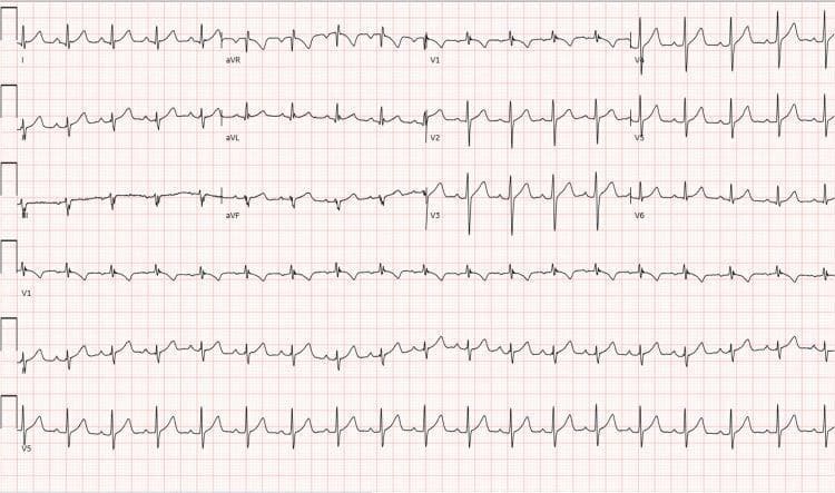 A standard 12-lead electrocardiogram (ECG) displayed in a multi-channel format, including rhythm strips at the bottom. The tracing demonstrates a normal sinus rhythm with a heart rate of approximately 82 beats per minute. P-wave morphology is normal and upright in leads I, II, and aVF, with a 1:1 AV relationship. QRS complexes are narrow (<120 ms) with normal R-wave progression in the precordial leads (V1-V6). No significant ST-segment deviations (elevation or depression), pathological Q waves, or T-wave inversions are observed. Notably, despite clinical context of severe hypokalemia (2.1 mmol/L) and thyrotoxicosis, this specific tracing lacks characteristic features of hypokalemia such as prominent U waves or ST-segment flattening. The ECG serves as an educational example of a regular sinus rhythm in a clinical case of thyrotoxic periodic paralysis.