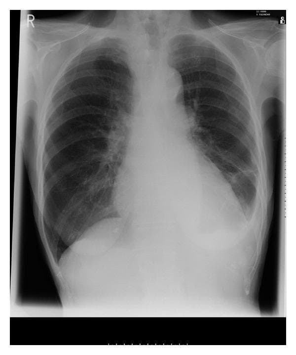 This diagnostic image is an anterior-posterior (AP) chest X-ray demonstrating bilateral pleural effusions. The most prominent radiographic feature is the presence of increased basal opacities with associated blunting of the costophrenic angles, characteristic of fluid accumulation in the pleural space. The effusion is more pronounced on the left side, where the meniscus sign is visible against the lateral chest wall, partially obscuring the left cardiac border and the left hemidiaphragm. The right costophrenic angle also shows moderate blunting. The heart silhouette appears slightly enlarged or obscured by the surrounding pleural fluid. The upper and middle lung fields remain relatively clear without evidence of focal consolidation, masses, or pneumothorax. The mediastinum is centrally positioned. The bony thorax, including the ribs and clavicles, appears intact. This image illustrates a common manifestation of systemic or pulmonary disease and serves as an educational example of how pleural fluid alters normal thoracic landmarks on plain film radiography.