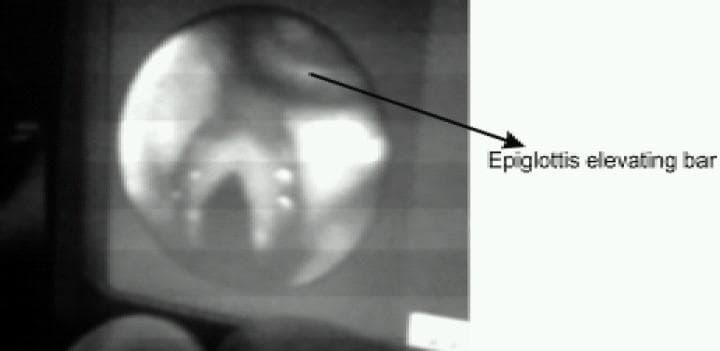 A fiberoptic endoscopic view of the larynx obtained through an LMA CTrach system. The circular field of view captures the glottic opening, including the laryngeal inlet and vocal cords positioned centrally. An arrow labels the 'Epiglottis elevating bar,' a mechanical component of the LMA CTrach device visible at the top of the frame. This bar is designed to lift the epiglottis away from the glottis to facilitate visualization and subsequent passage of an endotracheal tube (ETT). The image demonstrates the internal anatomical orientation required for successful blind or visually-guided intubation using a supraglottic airway with integrated fiberoptic channels. The educational focus is on the clinical application of airway management devices and the recognition of laryngeal structures through a video-assisted intubating laryngeal mask airway.