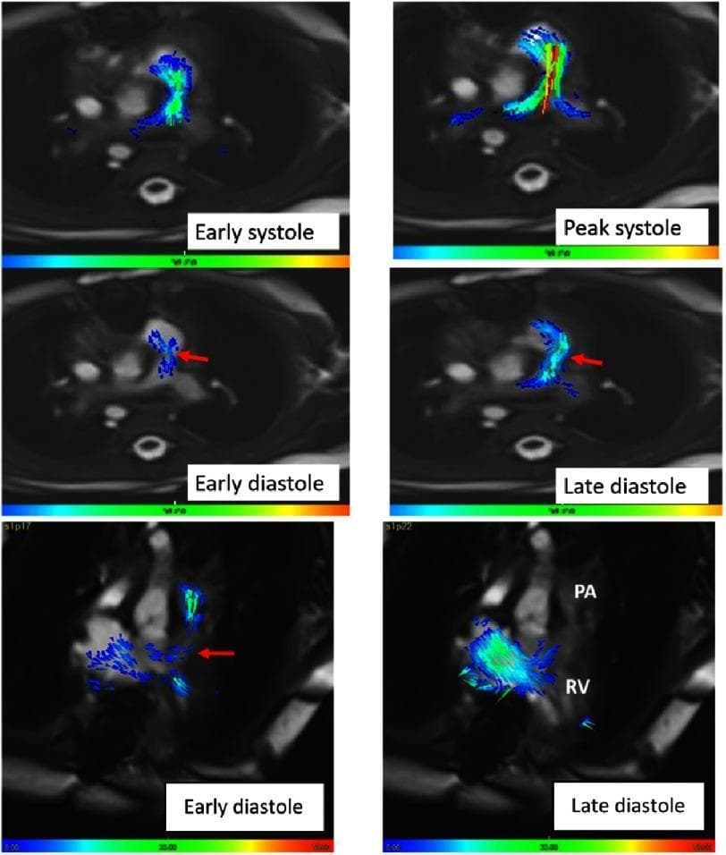 This diagnostic visual consists of multiple panels of functional cardiovascular magnetic resonance (CMR) imaging with 4D flow mapping, illustrating hemodynamic patterns in a post-operative neo-pulmonary artery (PA). The panels are organized by cardiac cycle phases: early systole, peak systole, early diastole, and late diastole. In early systole, flow is laminar and concentrated at the right ventricular (RV) outflow tract. During peak systole, velocity increases, indicated by a color shift from blue to yellow/red and elongated streamlines extending into the PA bifurcation. Early diastole shows a marked reduction in flow length with emerging direction changes. Late diastole demonstrates a distinct reversal of flow from the neo-pulmonary artery back toward the right ventricle, marked by red arrows and retrograde streamlines. These images evaluate post-surgical outcomes in complex congenital heart disease (such as truncus arteriosus repair), specifically assessing the efficiency of the neo-pulmonary conduit and the presence of diastolic regurgitation. The flow mapping provides critical data on velocity gradients and volumetric flow across the cardiac cycle.