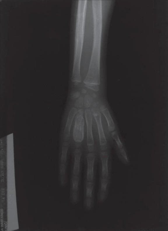 This diagnostic image is a posterior-anterior (PA) X-ray of a pediatric hand and distal forearm demonstrating a classic case of tuberculous dactylitis, also known as spina ventosa. The primary finding is significant fusiform expansion and cortical thinning of the fourth metacarpal bone. The diaphysis appears markedly enlarged and contains heterogeneous, cystic-like material with varying density, suggesting chronic granulomatous inflammation and osteomyelitis. In contrast, the adjacent metacarpals and phalanges maintain a more typical morphology and bone density, though some periosteal reaction may be present in other segments. The carpal bones and distal radius/ulna are visible but appear largely unaffected by the focal metacarpal expansion. This radiological presentation is highly characteristic of skeletal tuberculosis in children, reflecting the cyst-like expansion and internal 'wind-filled' (spina ventosa) appearance of the short tubular bones.