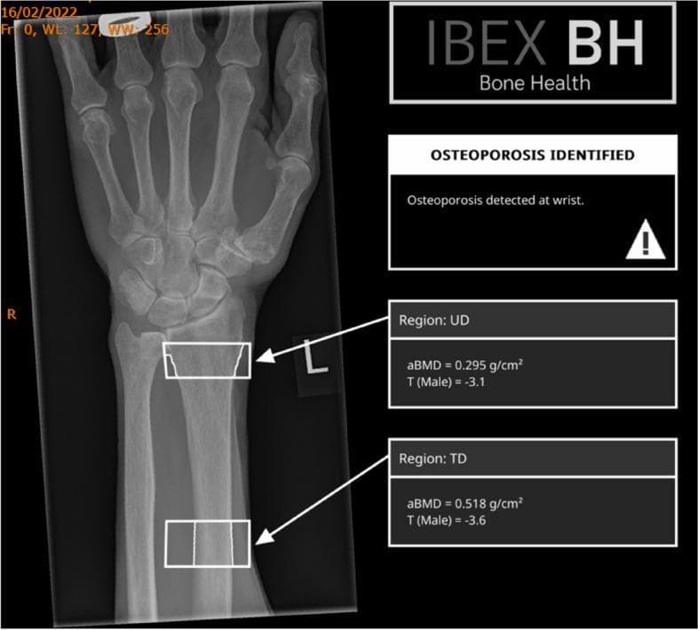An IBEX Bone Health DICOM report displaying an automated bone mineral density (BMD) analysis on a posterior-anterior (PA) radiograph of a human forearm and wrist. On the left, the X-ray shows the distal radius, ulna, and carpal bones with two superimposed white rectangular Regions of Interest (ROI). The superior ROI is placed at the ultra-distal (UD) radius, and the inferior ROI is placed at the distal-third (TD) shaft of the radius. On the right, diagnostic text boxes indicate 'OSTEOPOROSIS IDENTIFIED' with a warning symbol. Quantitative data for each region is provided: the UD region shows an areal BMD (aBMD) of 0.295 g/cm² and a male-referenced T-score of -3.1, while the TD region shows an aBMD of 0.518 g/cm² and a T-score of -3.6. This diagnostic tool is used for osteoporosis screening and risk assessment by deriving bone density metrics from standard digital radiographs.