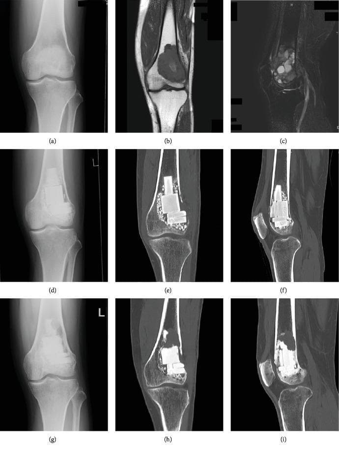 Multi-modal diagnostic imaging sequence (X-ray, MRI, CT) illustrating a Giant Cell Tumor of Bone (GCTB) in the distal femur and its postoperative progression. Top row: (a) Plain radiograph showing an ill-defined osteolytic lesion in the distal femoral metaphysis; (b) T1-weighted MRI showing a homogenous low-signal intensity mass; (c) T2-weighted fat-suppressed MRI showing heterogeneous intermediate-to-high signal intensity. Middle row: (d) Postoperative radiograph and (e, f) coronal/sagittal CT scans at 1 month showing the curetted cavity filled with radiopaque beta-tricalcium phosphate (β-TCP) blocks and surrounding granular particles. Bottom row: (g) Radiograph and (h, i) CT scans at 13 months post-operation demonstrating local recurrence characterized by new osteolysis predominantly within the β-TCP blocks and adjacent thinning of the cortical bone. This sequence serves as a clinical case study for evaluating bone substitute integration versus tumor recurrence using longitudinal multi-modal imaging.
