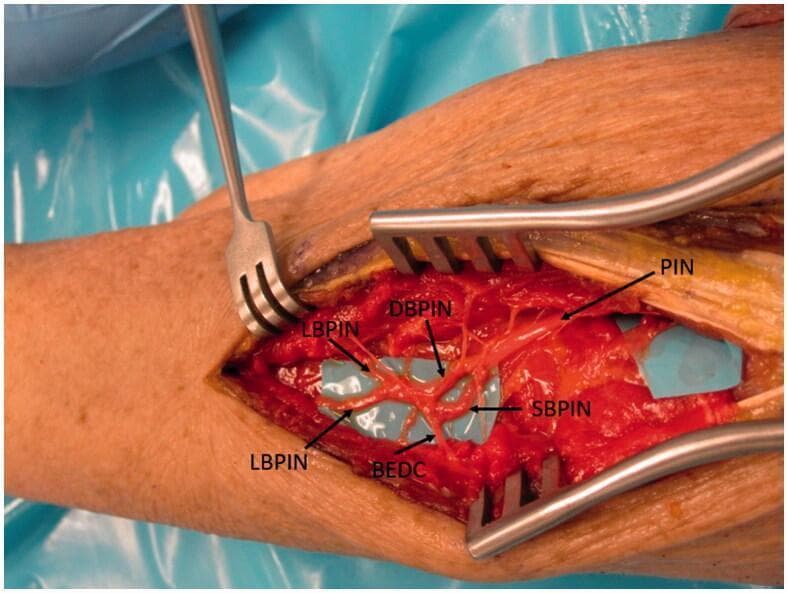 This clinical photograph displays a surgical dissection of the human forearm, focusing on the peripheral nervous system anatomy of the radial nerve. The primary structure shown is the Posterior Interosseous Nerve (PIN) as it courses distally through the extensor compartment. The image highlights a complex branching pattern: the main PIN trunk bifurcates into the Deep Branch (DBPIN) and the Superficial Branch (SBPIN). Further distal arborization is visible, including the lateral branches (LBPIN) and the specific branch to the extensor digitorum communis (BEDC). The nerves are meticulously isolated and placed over blue background material for visual contrast against the red muscular and soft tissue. Surgical retractors are in situ, maintaining exposure of the deep forearm musculature. This anatomical specimen demonstrates the terminal motor innervation of the wrist and finger extensors, critical for understanding PIN palsy, nerve entrapment syndromes, and reconstructive nerve transfer procedures such as AIN-to-PIN transfers.