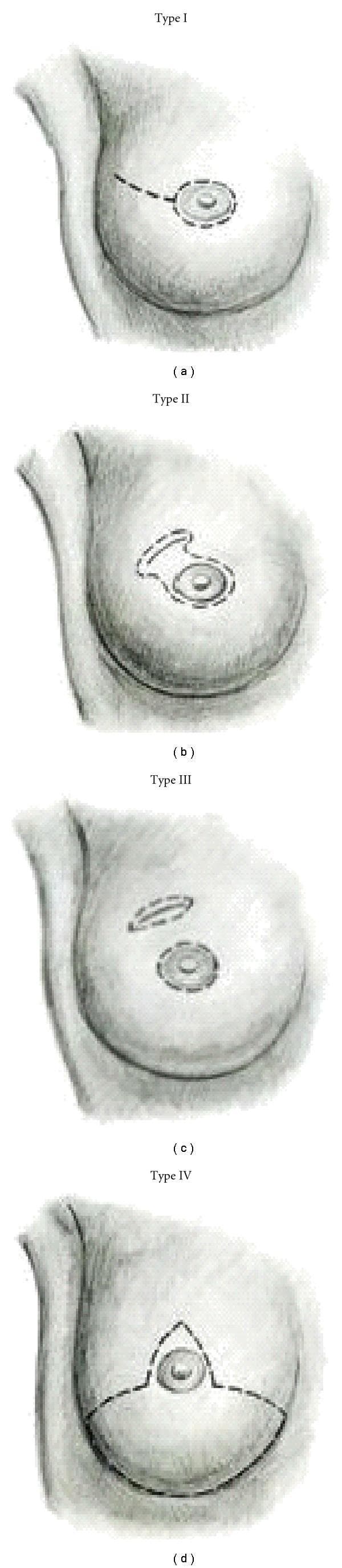 This medical illustration depicts four classification types (Type I to Type IV) of skin-sparing mastectomy (SSM) incisions on the female breast, categorized by the pattern of skin preservation and resection. Type I shows a periareolar incision with an optional lateral extension (tennis racquet pattern) toward the axilla. Type II demonstrates an expanded periareolar incision that incorporates an adjacent area of skin, typically used when superficial tumors or prior biopsy sites are near the areola. Type III features two distinct incisions: a circular periareolar incision and a separate elliptical incision remote from the areola, designed to remove skin overlying a distant tumor or biopsy scar while preserving the intervening bridge. Type IV utilizes a Wise pattern (T-shaped) incision, common in large or ptotic breasts requiring reduction, which includes an inverted-T pattern extending to the inframammary fold. The diagram serves as a clinical guide for oncologic surgeons to select incision patterns based on tumor location, prior scarring, and planned breast reconstruction techniques.