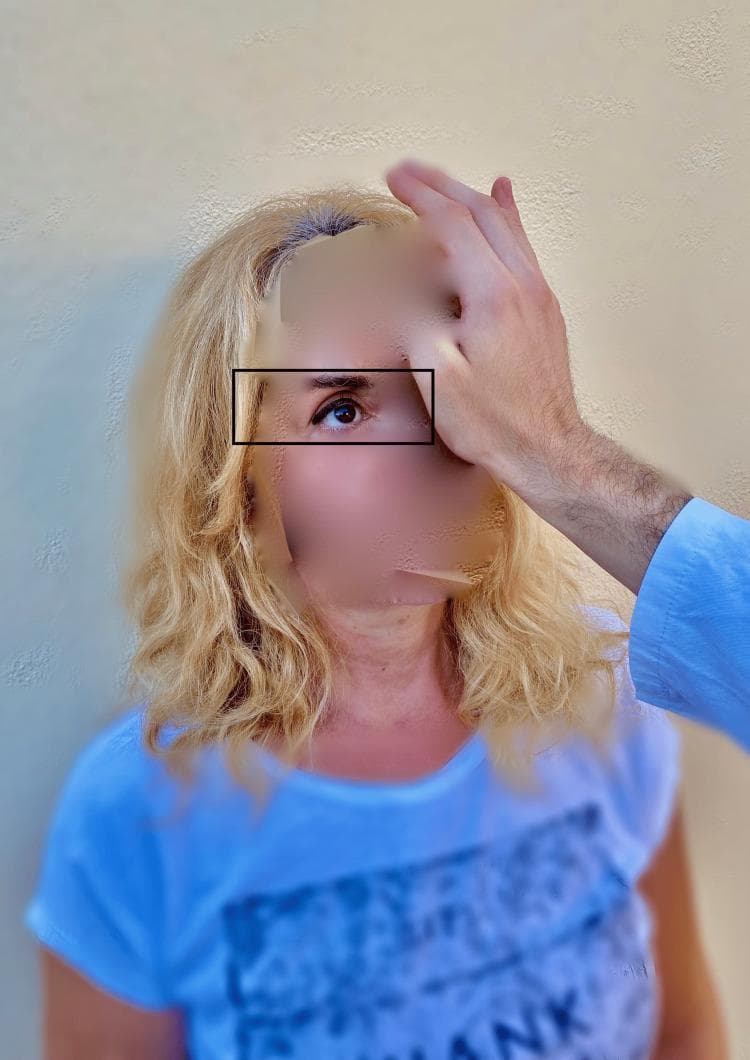 A clinical photograph demonstrating the 'test of skew,' a component of the HINTS (Head Impulse, Nystagmus, Test of Skew) examination used to differentiate central from peripheral causes of acute vestibular syndrome. The image shows an examiner’s hand placed over a patient's left eye while the patient's right eye remains uncovered and is highlighted by a rectangular box to indicate observation. During this maneuver, the examiner performs an alternate cover test while the patient maintains fixation on a central target (typically the examiner’s nose). The clinical focus is to detect skew deviation—a vertical ocular misalignment. In central vestibular disorders, such as a brainstem stroke, uncovering an eye may reveal a corrective vertical shift (refixation saccade). Conversely, the absence of vertical deviation, as seen in this clinical demonstration, is more characteristic of peripheral vestibular conditions like vestibular neuritis. This diagnostic procedure is essential for evaluating patients presenting with continuous vertigo, nystagmus, and nausea.
