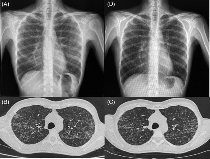 This composite clinical diagnostic image presents a longitudinal comparison of thoracic imaging findings in a patient with pulmonary sarcoidosis. Panels (A) and (D) are posteroanterior chest X-rays. Image (A) reveals diffuse, bilateral, discrete pulmonary infiltrates distributed throughout both lung fields. Image (D), taken over a year later, demonstrates the chronicity of these findings with stable bilateral interstitial opacities. Panels (B) and (C) show axial non-contrast chest CT scans at the level of the upper lobes. Image (B) highlights diffuse, bilateral micronodular pulmonary infiltrates with a distinct perilymphatic distribution, particularly along the peribronchovascular bundles and interlobar fissures. Image (C) shows the same anatomical section months later, indicating persistent micronodularity without significant radiological progression or resolution. The series illustrates the typical radiological presentation of pulmonary sarcoidosis, characterized by micronodular interstitial patterns that remain relatively stable over time, and demonstrates the utility of multi-modal imaging (X-ray and CT) in monitoring chronic granulomatous lung disease.