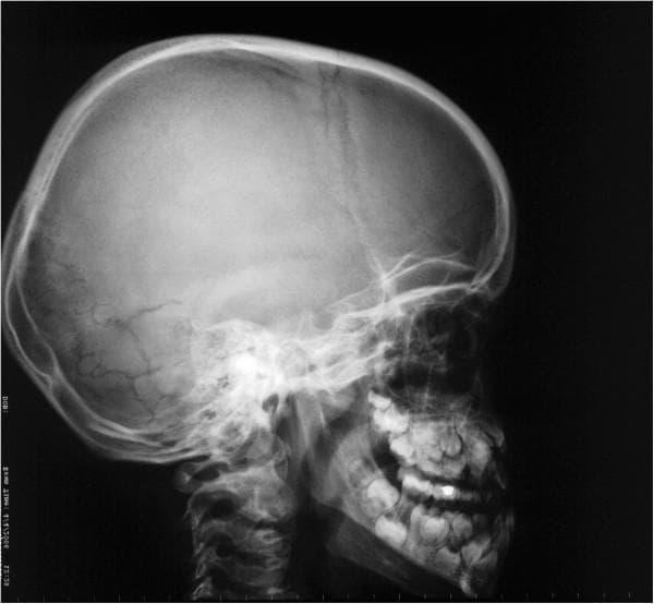 A lateral cephalometric radiograph of the skull illustrating characteristic diagnostic features of cleidocranial dysplasia (CCD). The cranial vault displays open sutures and persistent, large fontanelles, contributing to a bulging calvarium appearance. Numerous Wormian bones—small, irregular accessory bone islands—are prominently visible within the lambdoidal sutures. Facial skeletal findings include marked maxillary hypoplasia and a relatively prognathic mandible, resulting in a skeletal Class III relationship. The dental presentation shows a complex mixed dentition with delayed eruption of permanent teeth, retention of primary teeth, and multiple impacted supernumerary teeth. These radiographic markers are highly representative of a generalized skeletal dysplasia affecting intramembranous bone formation.