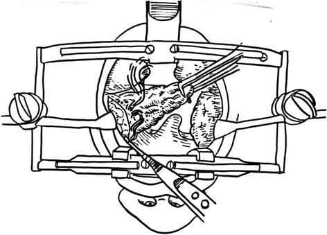 This surgical illustration depicts an intraoperative view of a tonsillectomy procedure, emphasizing the dissection technique. A specialized mouth retractor (such as a Dingman or McIvor system) is positioned to provide wide exposure of the oropharynx. The medial portion of the palatine tonsil is firmly grasped with right-angled Kelly clamps, applying medial traction to create necessary tension on the surgical plane. A monopolar electrocautery device is shown performing a precise incision along the base of the tonsil, targeting the extracapsular plane. The drawing illustrates the anatomical relationship between the tonsillar tissue, the anterior/posterior pillars, and the surrounding pharyngeal mucosa. This visual serves as an educational guide for Otorhinolaryngology trainees on the surgical steps of cold or hot dissection tonsillectomy, highlighting the importance of instrument placement, tissue traction, and the use of thermal energy for simultaneous cutting and hemostasis.