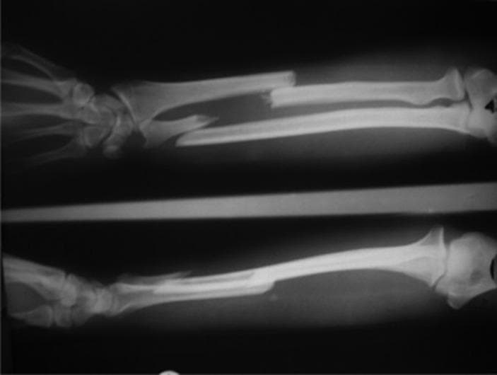 This diagnostic image consists of two X-ray views (radiography) of the forearm of a 42-year-old male, demonstrating complex fractures of the radius and ulna. The superior view displays a diaphyseal fracture of both bones: the radius presents a comminuted fracture mid-shaft with evident fragment separation, while the ulna shows a displaced fracture in the proximal to mid-shaft region. The inferior view provides an alternative longitudinal perspective, highlighting a distal-third radial fracture with significant displacement and overriding of the bony fragments, along with a more proximal ulnar fracture line. Clinical significance includes the assessment of forearm alignment and the integrity of the interosseous membrane in the context of orthopedic trauma. The image serves as an educational example of 'both-bone' forearm fractures, requiring evaluation for surgical stabilization and potential complications like compartment syndrome or infection.
