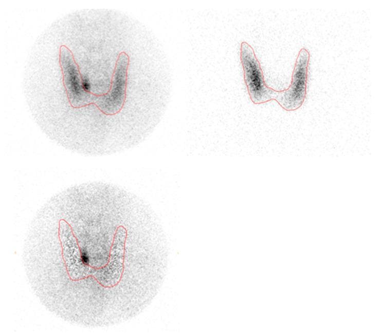 This diagnostic image demonstrates dual-isotope planar pinhole subtraction scintigraphy for parathyroid localization. The display consists of three panels depicting the thyroid and parathyroid regions. The upper left panel shows a 99mTc-sestamibi (MIBI) pinhole scan, which highlights both thyroid and hyperfunctional parathyroid tissue. The upper right panel displays a 123I pinhole scan, which selectively images the thyroid gland, showing the characteristic 'U' or 'V' shaped morphology. Both upper images include a red outline of the thyroid gland. The bottom left panel shows the subtraction image, created by removing the thyroid signal (123I) from the MIBI signal. This subtraction reveals a distinct focal area of high tracer intensity (hot spot) on the left side of the thyroid, consistent with a parathyroid adenoma. This imaging technique is a clinical standard in nuclear medicine for identifying ectopic or enlarged parathyroid glands in patients with primary hyperparathyroidism by isolating uptake that does not correspond to thyroid tissue.