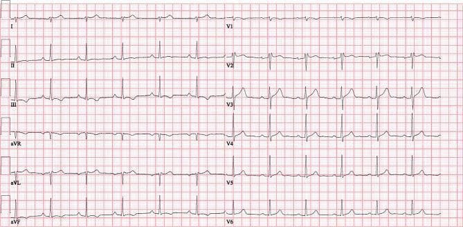 A standard 12-lead electrocardiogram (ECG) recorded at a paper speed of 25 mm/s and voltage calibration of 10 mm/mV. The tracing is displayed on a standard red grid comprising small (1 mm) and large (5 mm) squares. The ECG shows the limb leads (I, II, III) and augmented limb leads (aVR, aVL, aVF) on the left, and precordial chest leads (V1 through V6) on the right. The rhythm appears to be a normal sinus rhythm with regular P-waves preceding each QRS complex. The QRS complexes exhibit normal morphology and duration across all leads, with appropriate R-wave progression from V1 to V6. T-waves are concordant with the QRS complexes and appear stable. This diagnostic image represents a follow-up recording demonstrating the resolution of previous conduction disturbances, used in a clinical context for monitoring cardiac recovery and post-treatment stabilization.