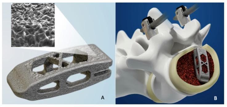 This medical illustration consists of two panels showcasing 3D-printed titanium spinal interbody fusion technology. Panel A presents a high-resolution view of a 3D-printed titanium cage, featuring a porous, lattice-based architecture designed for osseointegration. A magnified inset highlights the micro-topography of the surface, showing a roughened, irregular texture characteristic of powder bed fusion manufacturing, which enhances cellular adhesion. The cage exhibits a wedge-shaped profile with a central 'X' strut configuration and lateral apertures to accommodate bone graft material. Panel B is a clinical diagram showing the cage’s interbody placement within a lumbar vertebral segment. The cage is embedded within a bed of granular bone graft (represented in dark red) inside the vertebral body to facilitate arthrodesis. The diagram also illustrates surgical instrumentation (pedicle screw components) attached to the posterior elements of the vertebrae, providing a comprehensive view of the mechanical and biological integration required for spinal fusion procedures.
