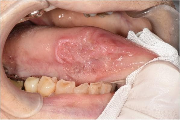 This clinical photograph displays a primary lesion on the right lateral border of the tongue in an adult patient. The lesion is a large, irregularly shaped ulcer with raised, indurated, and rolled-out edges, characteristic of oral squamous cell carcinoma. The central portion of the lesion exhibits a heterogeneous surface with areas of granulation, erosion, and mucosal thickening. The surrounding tongue tissue appears edematous. Visible anatomical context includes the lower dentition, which shows signs of wear and attrition, and the oral vestibule retracted by a dental speculum. A gloved hand and surgical gauze are visible at the right of the frame, indicating a clinical examination or preoperative setting. The lesion is located approximately midway between the tongue tip and the posterior lateral border, illustrating a classic presentation for intraoral malignancy. This image is an educational resource for dental and medical students to identify suspicious oral mucosal changes and understand the clinical morphology of tongue ulcers.