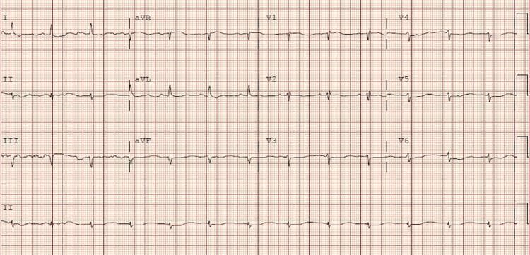 A standard 12-lead electrocardiogram (ECG) on red grid paper demonstrating a narrow complex sinus rhythm at a rate of approximately 78 beats per minute. The rhythm is regular with consistent P-wave morphology and a stable PR interval, indicating a sinoatrial node origin. The QRS complexes are narrow (within normal limits), suggesting normal intraventricular conduction. Noteworthy features include deep, pathologic-appearing Q waves in the inferior leads (II, III, and aVF), which may indicate a prior inferior myocardial infarction. The ST segments are generally isoelectric, although very mild ST-segment depression is visible in some leads. T waves appear upright in most leads but show relatively low amplitude. There is no clear evidence of prominent U waves. The calibration signal (10mm/mV) is visible on the far right. This ECG serves as an educational example of monitoring cardiac rhythm and conduction stability in the context of critical illness and metabolic recovery.