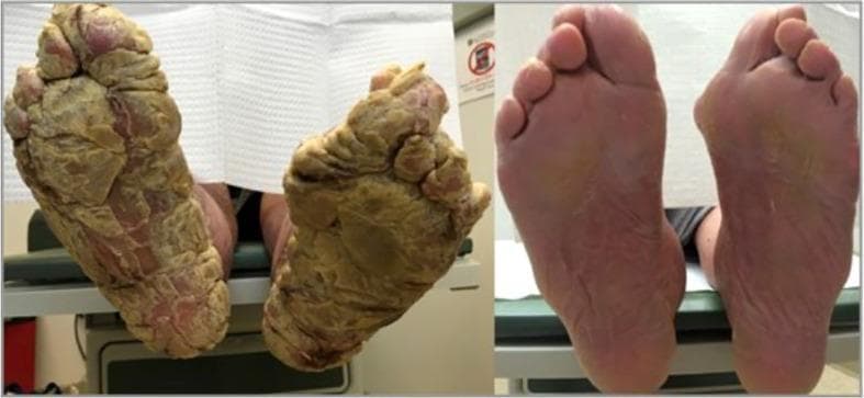This clinical photograph presents a side-by-side comparison of acquired palmoplantar keratoderma in a patient with severe hypothyroidism, showcasing the appearance at diagnosis (left) and after four months of levothyroxine treatment (right). The 'before' image displays the bilateral plantar surfaces with massive, diffuse hyperkeratosis. The skin is characterized by a yellowish-brown, verrucous texture with deep ridges, fissures, and thick adherent scales that distort the normal anatomy of the feet. Focal areas of erythema are visible beneath the shedding scale. In contrast, the 'after' image demonstrates a near-complete resolution of the keratoderma. The plantar skin appears significantly thinner, smoother, and maintains a healthy pinkish-white hue with a return of normal dermatoglyphics and foot contour. This case highlights the clinical presentation of secondary palmoplantar keratoderma as a cutaneous manifestation of endocrine dysfunction and demonstrates the efficacy of systemic hormonal correction over standard topical keratolytics in metabolic-associated skin disease.