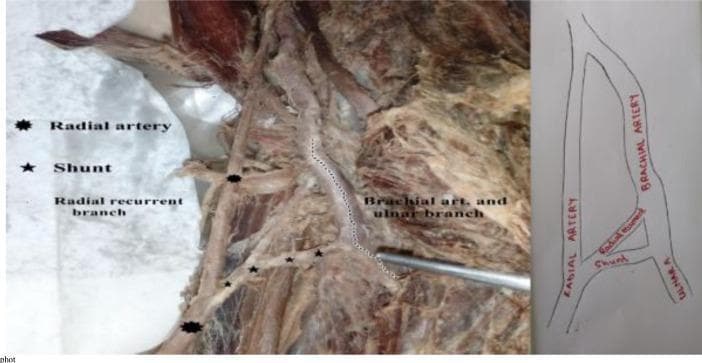 This composite image features a clinical photograph of a human cadaveric dissection (left) and a corresponding schematic diagram (right) of the cubital fossa, illustrating an anatomical variation of the upper limb vasculature. The primary focus is a vascular shunt (anastomosis) connecting the brachial artery to a high-origin radial artery. In this specimen, the radial artery originates proximally to the cubital fossa and descends laterally. The main brachial artery trunk is seen dividing into an ulnar branch medially. A distinct transverse communicating vessel, or shunt, is visible bridging the brachial/ulnar trunk to the radial artery. Notably, a radial recurrent branch is shown arising directly from this shunt rather than from the radial artery itself, traveling proximally toward the interval between the brachialis and brachioradialis muscles. This educational material demonstrates rare vascular patterns and arterial variations of the forearm, providing clinical relevance for surgical procedures, vascular access, and radiological interpretation in the cubital region.