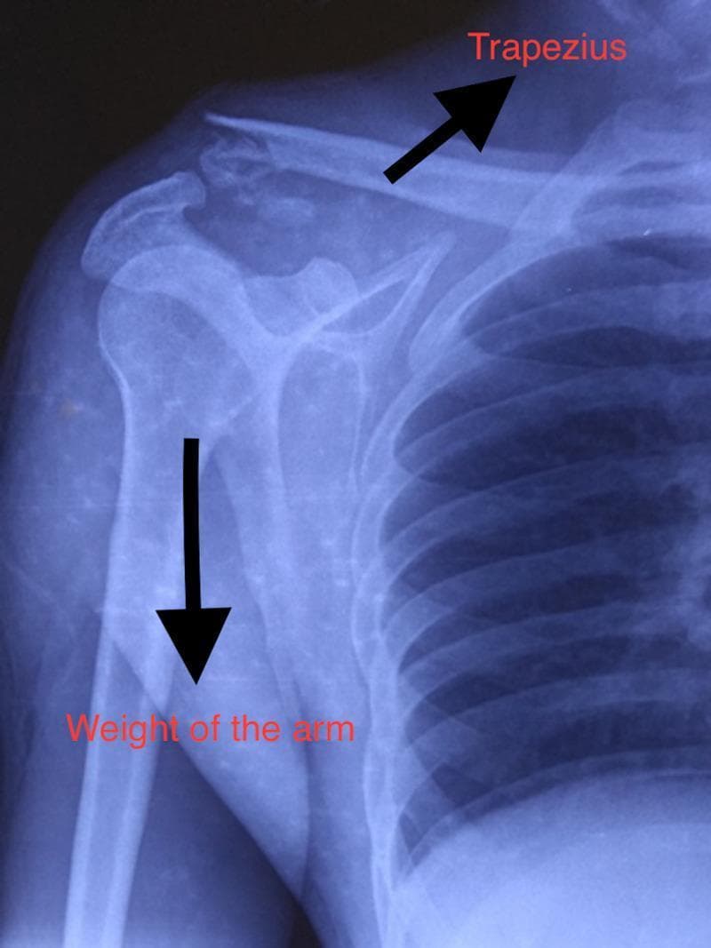This diagnostic image is an anteroposterior (AP) x-ray of the right shoulder demonstrating a Neer type II lateral end clavicle fracture. The skiagram reveals a complete cortical discontinuity at the distal third of the clavicle with visible comminution and fragmentation at the fracture site. Superior displacement of the proximal clavicular fragment is noted, indicated by an arrow labeled 'Trapezius,' representing the muscular force pulling the bone upward. A corresponding downward arrow labeled 'Weight of the arm' illustrates the gravity-driven inferior displacement of the distal fragment, humerus, and scapula. Other visible anatomical landmarks include the glenohumeral joint, acromion, coracoid process, and upper ribs. The image illustrates the classic displacing forces in distal clavicle fractures where coracoclavicular ligaments are often detached from the proximal segment, leading to instability. This clinical imaging is essential for orthopedic classification and pre-operative planning in trauma cases involving the shoulder girdle.