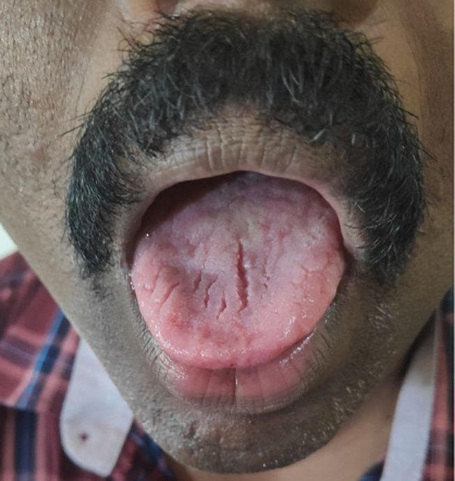 This clinical photograph shows an intraoral view of the tongue in a patient with a known diagnosis of myasthenia gravis (MG). The primary finding is a distinctly furrowed or fissured appearance of the dorsal surface of the tongue, characterized by multiple deep, longitudinal crevices and grooves. The tongue exhibits noticeable atrophy, evidenced by a reduction in muscular bulk and a flattened, wrinkled texture. The coloration is predominantly pale pink with localized areas of mild erythema. Such fissuring (scrotal tongue appearance) and lingual atrophy are rare clinical manifestations of MG, likely associated with bulbar muscle involvement and chronic weakness. The image serves as an educational example of atypical oral presentations in neuromuscular disorders, highlighting the importance of thorough physical examination in diagnosing and monitoring systemic disease progression.