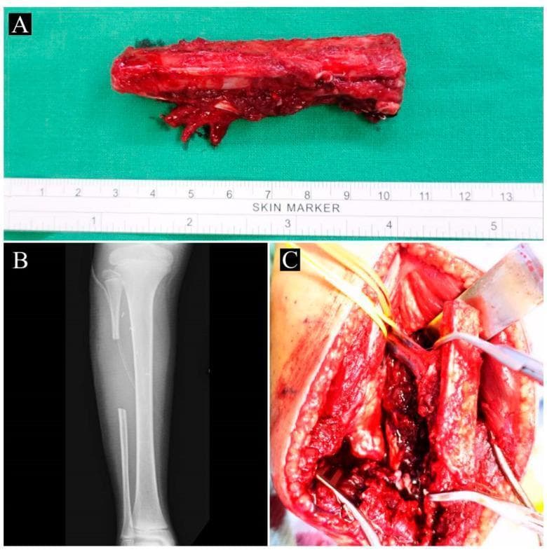 Educational composite image illustrating the harvesting of a contralateral vascularized fibular graft (VFG) for orthopedic reconstruction. Panel A is a clinical photograph of a harvested free fibular graft on a sterile green drape, showing approximately 10 cm of cortical bone with attached vascularized soft tissue and a visible vascular pedicle; a surgical skin marker ruler provides scale. Panel B is a postoperative anteroposterior X-ray of the donor lower leg, demonstrating the residual fibula with a segment missing from the mid-diaphysis, while preserving the proximal and distal ends to maintain knee and ankle stability. Panel C is an intraoperative clinical photograph showing the donor site dissection. It highlights the peroneal artery and accompanying veins identified with yellow vessel loops, and the fibular bone segment being mobilized. This sequence demonstrates the surgical technique for obtaining a vascularized autograft used in treating complex bone defects such as congenital pseudoarthrosis of the tibia (CPT). Relevant specialties include orthopedic surgery, microsurgery, and pediatric orthopedics.