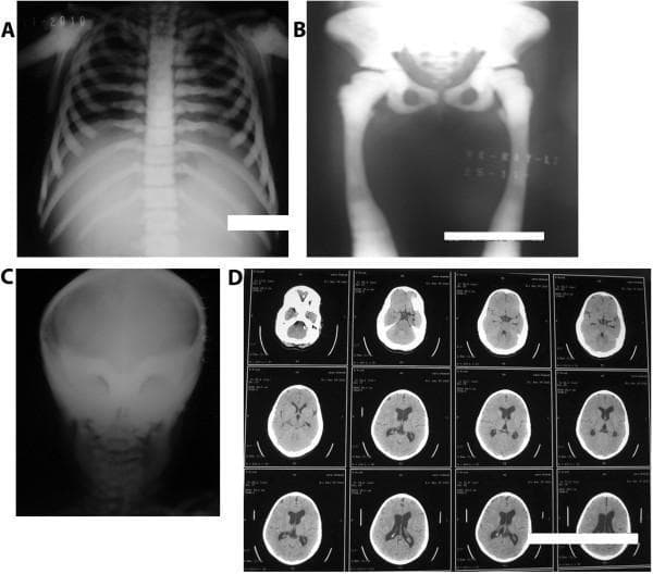 This composite of diagnostic images demonstrates pathognomonic radiological features of osteopetrosis (Albers-Schönberg disease). Panel A (chest/spine X-ray) shows generalized osteosclerosis with a characteristic 'sandwich vertebrae' sign, appearing as dense bands of sclerosis at the superior and inferior vertebral endplates. Panel B (pelvic and lower limb X-ray) exhibits diffuse thickening and a 'bone-within-bone' appearance in the iliac wings and proximal femurs. Panel C (skull X-ray) reveals a strikingly dense, homogenous sclerotic skull base and calvarium. Panel D (axial brain CT) demonstrates extreme hyperdensity of the skull, encroachment of the optic foramina due to bony overgrowth, and secondary mild dilatation of the lateral and third ventricles, indicating potential hydrocephalus or intracranial pressure changes. These features are hallmark signs of impaired osteoclast function leading to defective bone resorption and excessive bone accumulation, typically seen in autosomal dominant osteopetrosis type II (ADO-II).