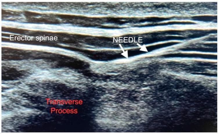 This diagnostic ultrasound image demonstrates the sonoanatomy required for an Erector Spinae Plane (ESP) block. The image shows a longitudinal view of the thoracic or lumbar paraspinal region. Key anatomical structures include the erector spinae muscle group, visible as superficial, parallel, hypoechoic layers, and the underlying transverse process of the vertebra, characterized by a highly echogenic (hyperechoic) curvilinear bony surface with posterior acoustic shadowing. An anesthetic needle is visualized using an in-plane technique, appearing as a linear hyperechoic structure. The needle tip is correctly positioned at the fascial plane between the deep aspect of the erector spinae muscle and the apex of the transverse process. This view is typical for regional anesthesia, illustrating the target site for local anesthetic deposition to achieve multisegmental analgesia. The image serves as an educational guide for ultrasound-guided interventional pain management and regional anesthesia protocols.