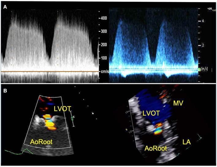 Transthoracic echocardiography (TTE) comparison between a 3D-printed circulatory flow model (left) and a clinical patient (right) evaluating aortic regurgitation (AR). Row A displays Continuous Wave (CW) Doppler spectral profiles, illustrating comparable peak velocities (approx. 400 cm/s) and similar decrescendo waveform envelopes during the diastolic phase, indicating consistent hemodynamics between the in vitro model and the in vivo subject. Row B presents Color Doppler flow mapping in the parasternal long-axis view. These images demonstrate a multi-colored regurgitant jet originating at the aortic valve and extending through the aortic root (AoRoot) into the left ventricular outflow tract (LVOT). In the patient image, the jet is seen passing the mitral valve (MV) toward the left atrium (LA). The color maps assist in assessing AR severity by visualizing the vena contracta width and jet area relative to the LVOT. The imagery demonstrates the utility of patient-specific 3D modeling for replicating complex valvular regurgitation patterns under varying hemodynamic conditions.