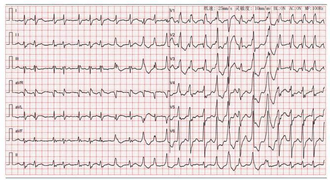 A standard 12-lead electrocardiogram (ECG) demonstrating a complex mixed arrhythmia in a patient with dilated cardiomyopathy and cardiogenic shock. The rhythm is irregularly irregular with the absence of discrete P waves, replaced by fine fibrillatory waves, characteristic of atrial fibrillation. Notable features include frequent premature ventricular complexes (PVCs) and a widened QRS duration (>120ms). Lead V1 shows a tall R wave followed by a deep S wave, and Lead V6 exhibits broad, slurred S waves, diagnostic of a complete right bundle branch block (RBBB). Significant ST-segment and T-wave abnormalities are visible across the precordial leads (V1-V6), likely representing secondary repolarization changes from the RBBB or underlying myocardial ischemia. The ECG indicates severe cardiac conduction system involvement and ventricular irritability in the context of acute decompensated heart failure.