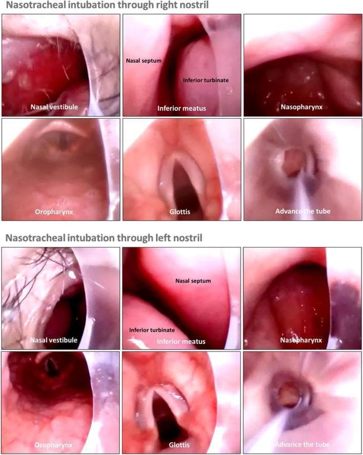 This clinical endoscopic comparison chart illustrates the anatomical progression of video rigid stylet-guided nasotracheal intubation through both the right and left nostrils. The image is organized into two rows of six frames each, documenting the view from initial entry to endotracheal tube advancement. Key anatomical landmarks labeled include the nasal vestibule, nasal septum, inferior turbinate, and inferior meatus within the nasal cavity. As the stylet-tube assembly progresses, the frames show the transition into the nasopharynx and oropharynx. The final stages depict the direct visualization of the glottis with clearly visible vocal cords, followed by the successful advancement of the beveled endotracheal tube into the trachea. This sequence demonstrates the clinical utility of video-assisted intubation in maintaining direct visualization of mucosal surfaces and laryngeal structures, regardless of the nostril selected, to minimize trauma and ensure accurate placement.