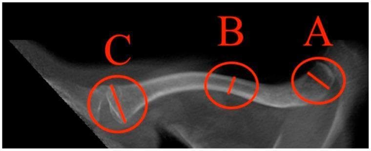 An anatomical diagram and diagnostic-style schematic of a human clavicle viewed from a superior perspective. The image illustrates standardized morphometric measurement points used in clinical imaging and forensic medicine. Three specific regions are highlighted with red circles and labeled with letters: 'A' indicates the maximal lateral diameter near the acromial end; 'B' represents the minimal diameter located at the midshaft (middle third) of the bone; and 'C' identifies the maximal medial diameter at the sternal end. The clavicle displays its characteristic 'S'-shaped double curvature, with a convex anterior medial portion and a concave anterior lateral portion. The visualization highlights structural differences, showing increased width and trabecular density at the articular ends compared to the more slender, cortical-dense midshaft. This diagram is utilized for teaching bone morphology, quantifying clavicular dimensions in orthopedic research, and establishing normative reference values for population studies.