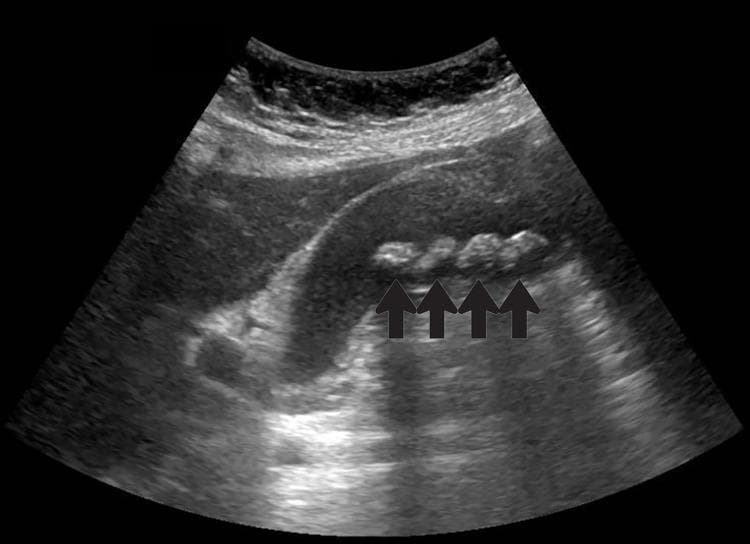 This diagnostic ultrasound image in the left lateral decubitus position demonstrates the gallbladder and adjacent liver parenchyma. The gallbladder lumen contains multiple curvilinear hyperechoic foci, indicated by four black arrows, consistent with cholelithiasis (gallstones). These stones exhibit distinct posterior acoustic shadowing, a hallmark sonographic sign of solid calcified structures. The gallbladder wall appears diffusely thickened, measuring approximately 6.3 mm, which is suggestive of cholecystitis. Trace amounts of anechoic pericholecystic fluid are visible, further indicating local inflammatory changes. The surrounding liver parenchyma displays a normal homogeneous echotexture. This image serves as a clinical example of symptomatic gallbladder disease, illustrating key diagnostic features used to identify acute cholecystitis and cholelithiasis during a transabdominal ultrasound examination.