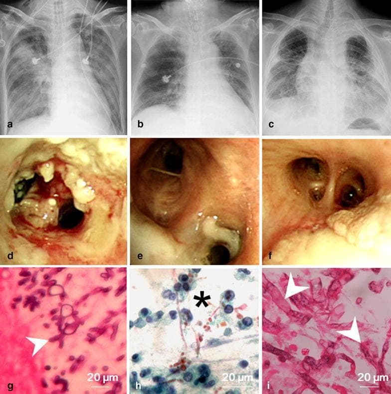 A multi-modal comparison of invasive fungal tracheobronchitis (IFT) caused by Aspergillus, Candida, and Mucorales. The composite consists of nine panels (a-i) organized by diagnostic modality. Panels a-c: Chest radiographs showing diffuse, bilateral pulmonary infiltrates and consolidations common across different fungal etiologies. Panels d-f: Bronchoscopic views demonstrating various endobronchial manifestations: (d) extensive pseudomembranous and ulcerative lesions with irregular surfaces (Aspergillus), (e) smooth whitish pseudomembranes (Candida), and (f) focal whitish plaques with associated airway inflammation (Mucorales). Panels g-i: Histopathological microscopy (400x magnification, 20 µm scale bars) highlighting diagnostic morphology: (g) septate hyphae with characteristic 45-degree acute-angle branching (Aspergillus), (h) yeast cells and elongated pseudohyphae (Candida), and (i) a mixed infection showing broad, thin-walled, non-septate hyphae (Mucormycete) alongside septate Aspergillus hyphae. This comparison illustrates that while radiographic and bronchoscopic findings may overlap, histopathology is critical for differentiating the specific fungal species in immunocompromised or critically ill patients.