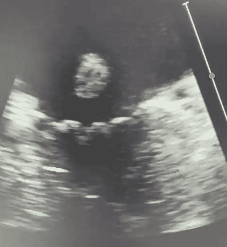 This diagnostic ultrasound image is a gray-scale transesophageal echocardiogram (TOE) capturing a mid-esophageal view of the mitral valve apparatus. The image demonstrates a flail anterior mitral valve leaflet, characterized by a lack of systolic coaptation and an irregular, detached appearance of the leaflet tip extending into the left atrium. The visual findings are consistent with acute mitral regurgitation resulting from structural failure of the subvalvular apparatus, such as chordae tendineae rupture or papillary muscle dysfunction. This clinical photograph serves as a critical educational tool for identifying primary valvular pathology and understanding the pathophysiology of severe, eccentric mitral regurgitation in the context of acute hemodynamic instability. The imaging highlights the importance of TOE in assessing cardiac valve morphology and ruling out conditions like infective endocarditis in patients with acute pulmonary edema.