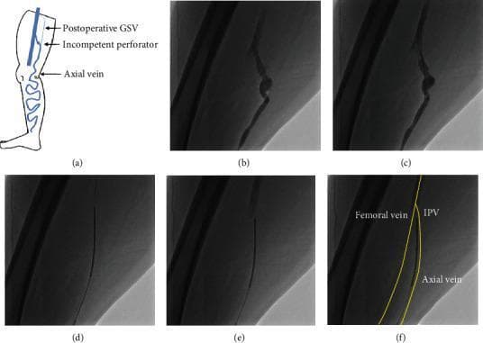 This composite educational graphic illustrates the venography and selective ablation technique (VSA) for treating recurrent varicose veins. Figure (a) provides an anatomical diagram of the lower limb showing a postoperative great saphenous vein (GSV), an incompetent perforator vein (IPV), and the axial vein. Figures (b-f) present sequential fluoroscopic images from a cardiovascular interventional procedure. Image (b) shows contrast-enhanced venography of a dilated IPV. In (c), a 0.025-inch guidewire is visualized crossing the IPV into the femoral vein (FV). Image (d) shows a radiofrequency ablation (RFA) catheter advanced over the wire into the FV. Images (e) and (f) demonstrate the withdrawal and positioning of the RFA catheter at the junction between the FV and the IPV, with (f) providing yellow-lined anatomical overlays identifying the Femoral vein, IPV, and Axial vein. The sequence illustrates the procedural steps for precisely targeting venous reflux in complex, obese patients where ultrasound visualization is limited, facilitating endovenous thermal ablation.