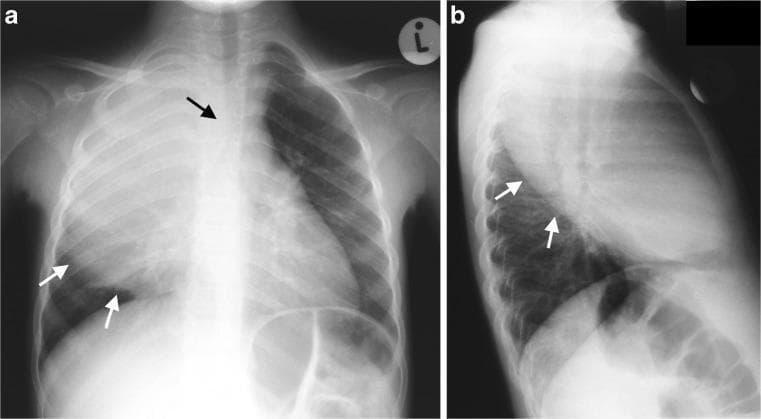This diagnostic imaging set consists of two chest radiographs of a 3-year-old pediatric patient: (a) an anteroposterior (AP) view and (b) a lateral view. The images demonstrate a dense, homogeneous opacity localized to the right upper lobe, consistent with severe consolidation. Key diagnostic features include a prominently bulging inferior margin (indicated by white arrows) of the minor fissure, suggesting an expansile process where the affected lobe has increased in volume. The AP view (a) further reveals a significant mass effect, with a black arrow highlighting the displacement and deviation of mediastinal structures, including the trachea, toward the left side. These findings are classic radiological signs of expansile pneumonia, frequently associated with Klebsiella pneumoniae infection. While the radiographs clearly show the dense consolidation and resulting volume expansion, they are limited in their ability to differentiate between simple congestion and more complex parenchymal changes such as necrosis or suppuration.