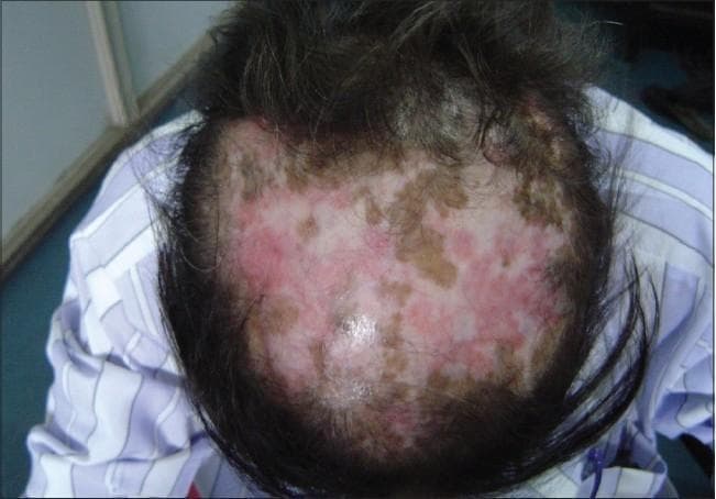This clinical photograph displays a superior view of the scalp demonstrating classic features of Discoid Lupus Erythematosus (DLE). The image reveals extensive, patchy scarring alopecia (cicatricial alopecia) characterized by a significant reduction in hair density and visible destruction of hair follicles. The skin lesions exhibit a tri-colored, variegated appearance: erythematous (pink-red) areas indicating active inflammation, hyperpigmented (brown-tan) macules and patches, and focal regions of porcelain-white hypopigmentation suggestive of established dermal fibrosis and scarring. The distribution is irregular across the vertex and crown, showing the progressive nature of the follicular damage. This visual serves as a primary educational example of the cutaneous manifestations of chronic cutaneous lupus erythematosus on the scalp, emphasizing the transition from active inflammatory plaques to permanent, irreversible hair loss.
