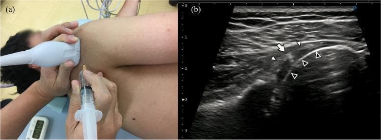 This composite image illustrates an ultrasound-guided glenohumeral joint injection procedure. Panel (a) is a clinical photograph showing the procedural setup: a patient in a lateral recumbent position with a clinician holding a linear ultrasound transducer against the posterior shoulder. A syringe and needle are being inserted out-of-plane relative to the transducer for joint access. Panel (b) is a corresponding ultrasound image in a transverse plane showing the musculoskeletal anatomy. The white arrowheads identify the hyperechoic glenohumeral joint capsule. The black arrowheads mark the humeral head, which exhibits a curvilinear hyperechoic cortex. A white arrow points to the needle tip, appearing as a focal hyperechoic reflective point positioned deep to the capsule within the joint space. This educational material demonstrates the precision of needle placement for intra-articular steroid or anesthetic delivery in orthopedics and physical medicine.